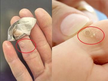 Truyền tay nhau cách trị mụn cóc này, hàng nghìn chị em đã chữa khỏi tận gốc!