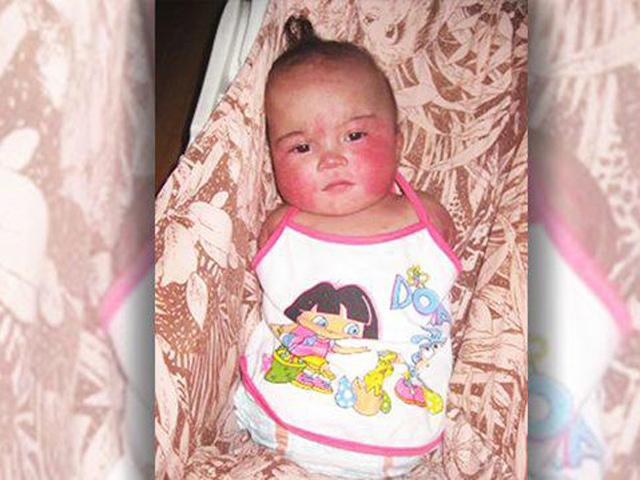 Cuộc sống của cô bé 6 tháng tuổi không tay chân bị bỏ rơi giờ ra sao?