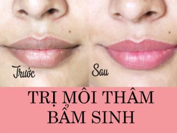Môi thâm bẩm sinh không còn là vấn đề nếu bạn biết đến những cách sau!