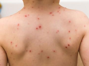 Đã mắc Rubella có mắc sởi nữa không?