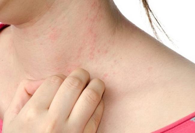Đã mắc Rubella có mắc sởi nữa không? - 1