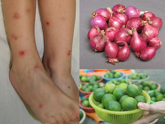 Chỉ dùng hành tím với chanh thôi mà sẹo thâm ở chân xoá sạch không dấu vết!