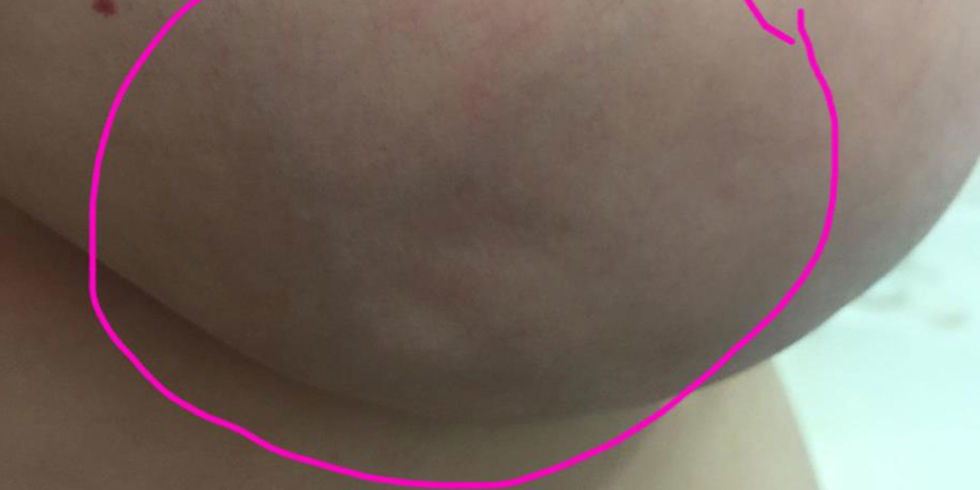 Lúm đồng tiền trên ngực: Coi chừng ung thư vú - 1