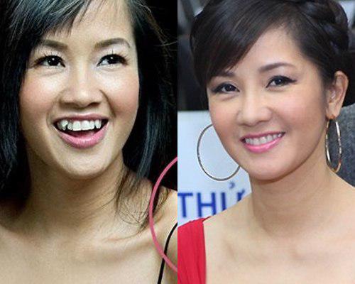 Thủy Tiên, Hồng Nhung chứng minh: niềng răng amp;#34;thăng hạngamp;#34; nhan sắc là có thật! - 1