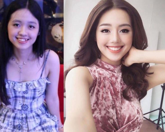 Thủy Tiên, Hồng Nhung chứng minh: niềng răng amp;#34;thăng hạngamp;#34; nhan sắc là có thật! - 3