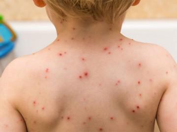 Trị thủy đậu không để lại sẹo chỉ bằng các nguyên liệu tự nhiên cực dễ kiếm