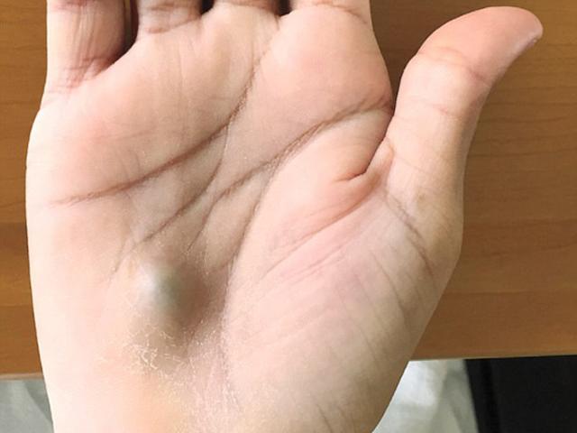 Lười vệ sinh răng miệng, thanh niên không ngờ mắc trọng bệnh chỉ từ khối u nhỏ