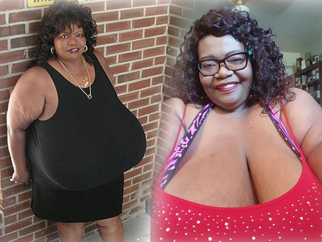 Người phụ nữ một bước lên tiên nhờ bộ ngực vĩ đại nhất thế giới do mắc bệnh lạ