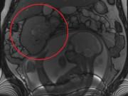 Bà bầu - Đi siêu âm thai, bà mẹ "choáng váng" khi thấy con đang đá một khối u to gần bằng mình