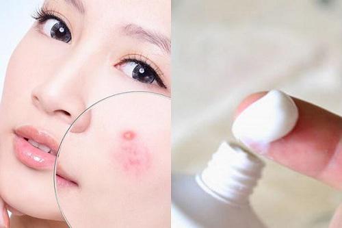 Bất ngờ trước cách trị mụn bọc chẳng tốn bao nhiêu tiền với kem đánh răng! - 5