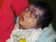 Làm mẹ - Bác sĩ Nhi khoa nhắc mẹ những kiến thức cần nắm vững khi trẻ bị thủy đậu