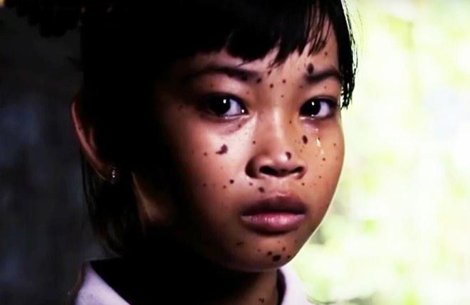 Cẩm Ly, Trấn Thành xót xa cô bé bị bạn bè gọi là “chó đốm” vì căn bệnh quái ác - 1