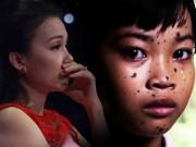 Giải trí - Cẩm Ly, Trấn Thành xót xa cô bé bị bạn bè gọi là “chó đốm” vì căn bệnh quái ác