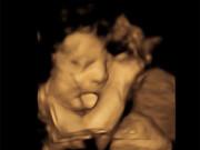 Bà bầu - Hào hứng khen bé lè lưỡi đáng yêu khi siêu âm, ngày sinh ra mẹ thẫn thờ nhìn mặt con