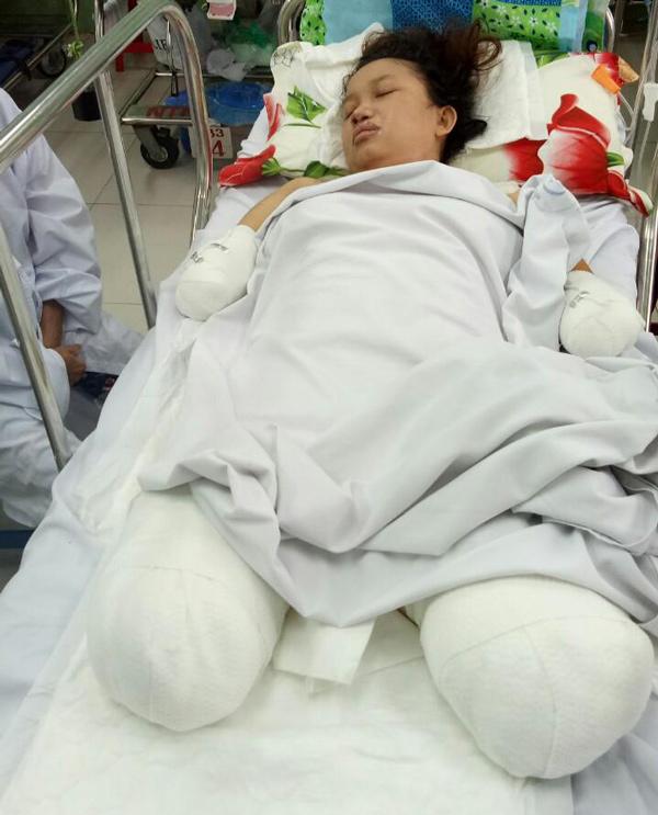 Tưởng chỉ bị tắc sữa, mẹ Bình Dương nuốt nước mắt đành cắt cụt tứ chi để được sống - 3