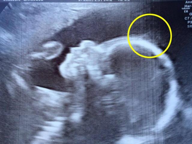 Siêu âm mẹ thấy dấu hiệu lạ trên đầu bé, giờ con 1 tuổi đã có 100.000 người hâm mộ