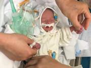 Bà bầu - Không khám thai theo lịch, mẹ Hà Nội nguy kịch, bác sĩ mổ đẻ ra bé trai 1kg mềm nhũn
