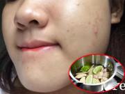 Làm đẹp - 2 cách trị mụn ẩn hiệu quả nhất, da đẹp đón Tết hơn cả đống mỹ phẩm đắt tiền