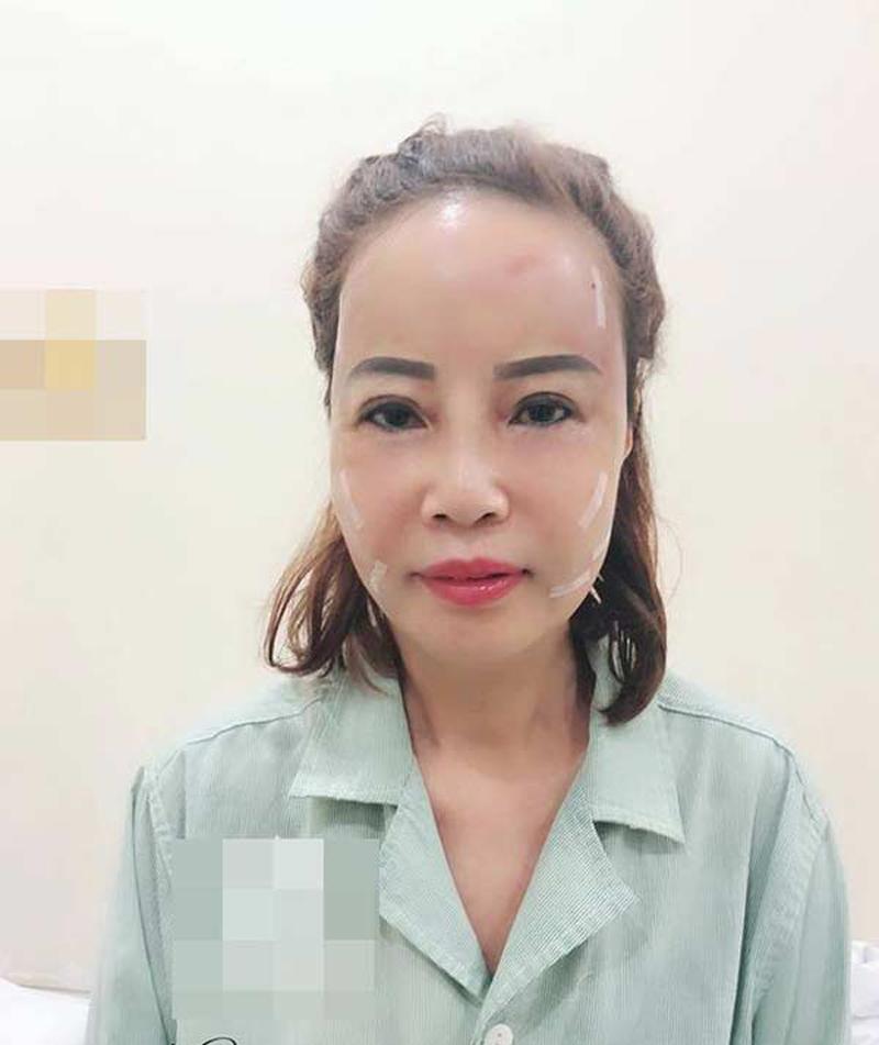 Theo thông tin từ cô dâu Thu Sao, cô đã cậy nhờ phương pháp căng da mặt bằng mỡ tự thân ở bụng để cấy lên mặt.
