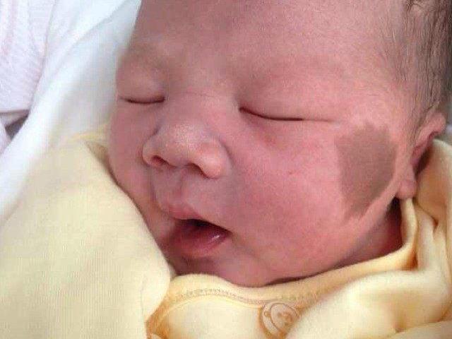 Con sinh ra với vết bớt trên mặt, mẹ ôm đầu hối hận khi bác sĩ nói nguyên nhân