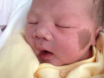 Con sinh ra với vết bớt trên mặt, mẹ   ôm đầu hối hận   khi bác sĩ nói nguyên nhân