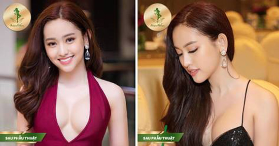 Nâng mũi Sform, Sform Plus - đột phá mới cho dáng mũi hoàn hảo - 1