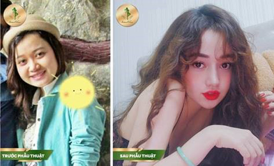 Nâng mũi Sform, Sform Plus - đột phá mới cho dáng mũi hoàn hảo - 2