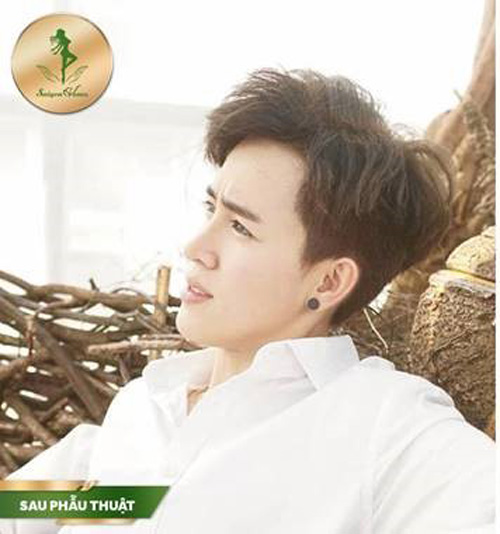 Nâng mũi Sform, Sform Plus - đột phá mới cho dáng mũi hoàn hảo - 4