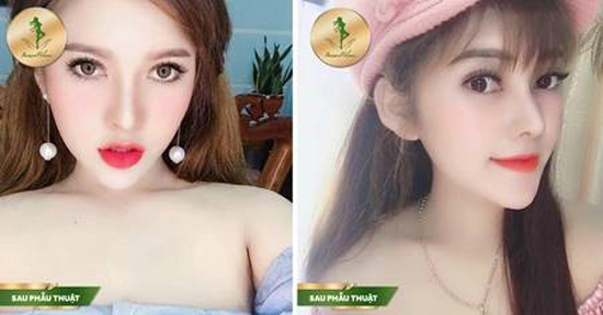 Nâng mũi Sform, Sform Plus - đột phá mới cho dáng mũi hoàn hảo - 5