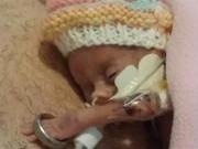 Tin tức - Bé sơ sinh nặng 0,48 kg, bàn tay nhỏ đến mức chui lọt nhẫn cưới của bố giờ ra sao?