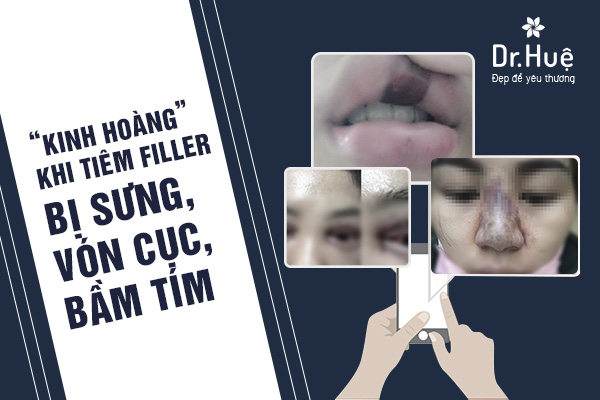 Tiêm filler bị vón cục, sưng đau, bầm tím - vì đâu nên nỗi? - 1