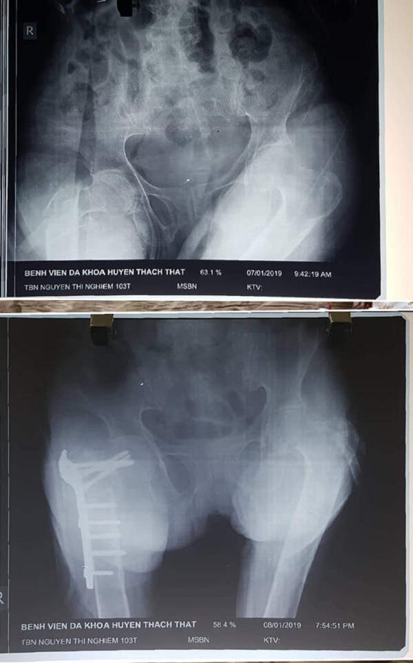 Lần đầu tiên bệnh viện tuyến huyện phẫu thuật, cứu sống bệnh nhân 103 tuổi bị gãy xương đùi - 2