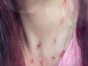 Nhờ soi vết lạ trên cổ bạn gái, chàng trai yêu xa biết mình có rổ sừng trên đầu