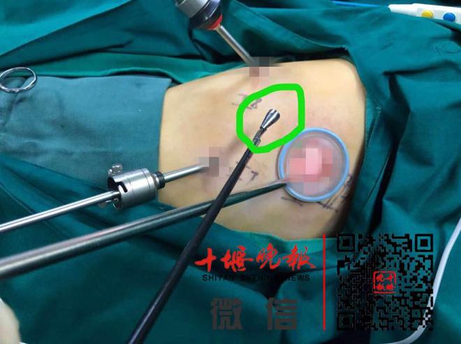 Bé gái 8 tuổi suýt mất mạng vì một thói quen mỗi khi ngồi vào bàn học - 2