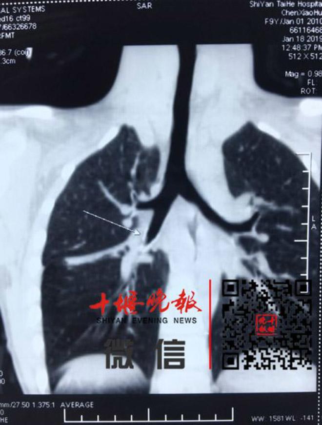 Bé gái 8 tuổi suýt mất mạng vì một thói quen mỗi khi ngồi vào bàn học - 1