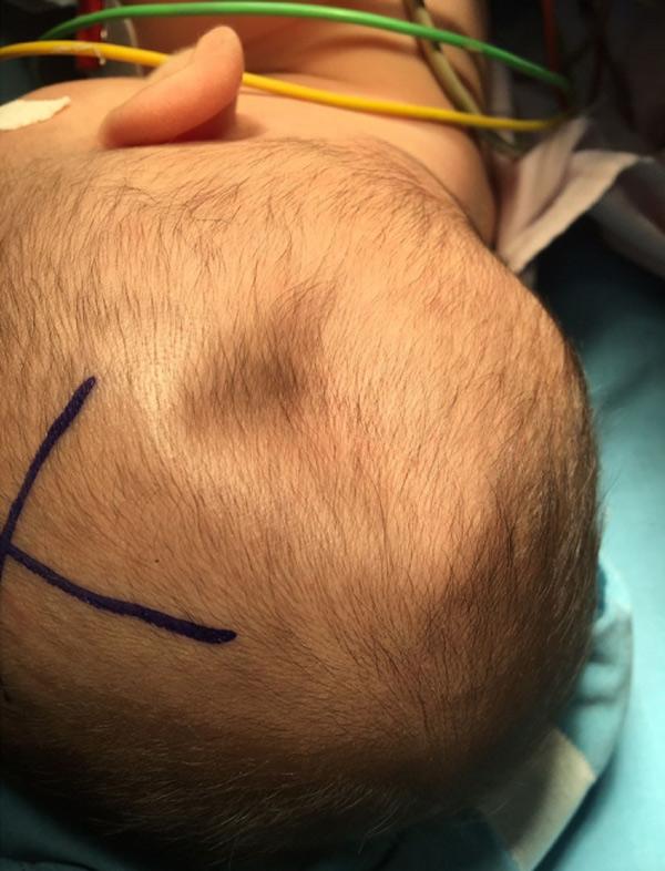 Cảnh giác với tình trạng trẻ chấn thương đầu do té ngã, đã có trường hợp bé lõm xương sọ - 1