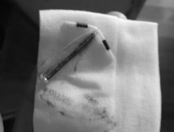 Đặt vòng tránh thai, 4 tháng sau mẹ Thanh Hóa hốt hoảng nhìn xuống dưới khi đi vệ sinh - 1