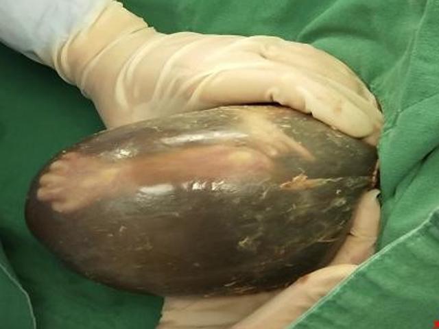 Mổ cấp cứu cho mẹ bầu 25 tuần, bác sĩ ngỡ ngàng nhìn thai nhi khi được lấy ra