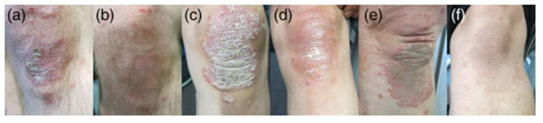 dieu tri hieu qua benh vay nen bang ket hop thao duoc - 2