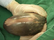 Bà bầu - Mổ cấp cứu cho mẹ bầu 25 tuần, bác sĩ ngỡ ngàng nhìn thai nhi khi được lấy ra