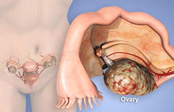 Người mẫu Kim Anh qua đời vì ung thư buồng trứng, phụ nữ có đặc điểm này dễ mắc bệnh - 3