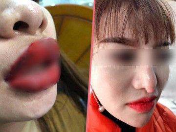 Cười không nổi với hậu quả làm đẹp đón Tết: mũi nhọn hoắt, môi như nuốt cả thế giới...