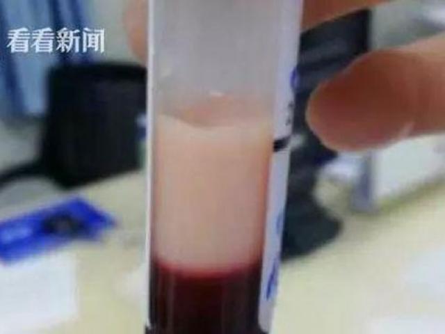 Máu của người đàn ông 33 tuổi biến thành sữa, chỉ vì thích ăn loại thực phẩm này