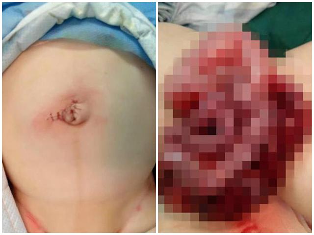 Thấy bụng con phình to tưởng đầy hơi, ông bố làm một việc khiến con lòi ruột ra ngoài