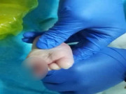 Làm mẹ - Bé 4 tháng hoại tử ngón chân, thủ phạm là vật dụng thân quen mẹ không ngờ tới