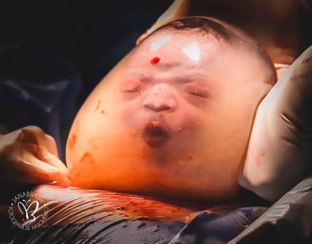 Bé trai sinh ra trong bọc ối, vừa chào đời đã lè lưỡi sau 1 tháng ra sao? - 2