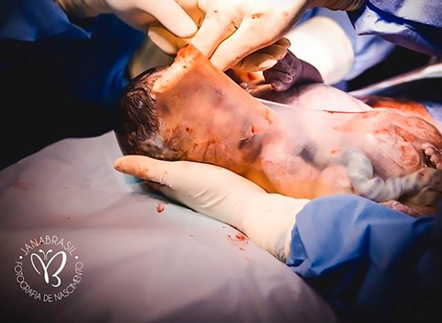 Bé trai sinh ra trong bọc ối, vừa chào đời đã lè lưỡi sau 1 tháng ra sao? - 3