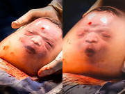 Tin tức - Bé trai sinh ra trong bọc ối, vừa chào đời đã lè lưỡi sau 1 tháng ra sao?