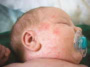 Làm mẹ - Dịch sởi diễn biến phức tạp, mẹ cần làm ngay những điều này để bảo vệ con khỏi mắc bệnh