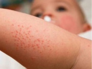 Sức khỏe - 3 dấu hiệu phân biệt bệnh sởi và sốt phát ban để trẻ không bị biến chứng, tử vong